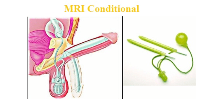 Aumento cirúrgico do pênis com implante