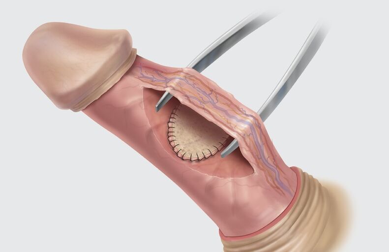 cirurgia para aumentar o pênis